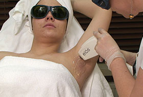 depilacja laserowa-2