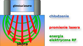 syneron2